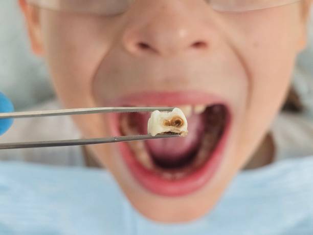 Best Emergency Dental Care for Broken or Chipped Teeth in Milford, UT